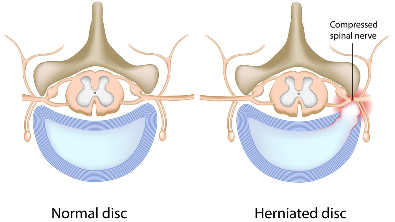 disc