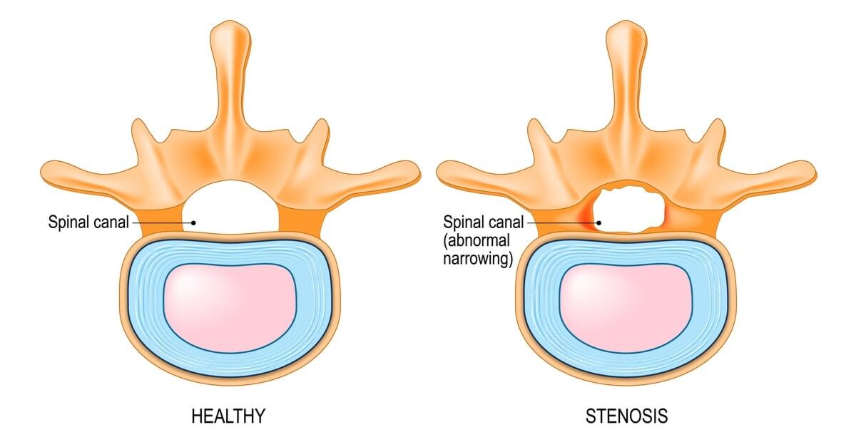 spinalstenosis